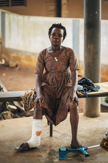 Micheline utiliza una muleta para poder desplazarse por el hospital, ya que su pierna derecha está incapacitada por la úlcera de Buruli.